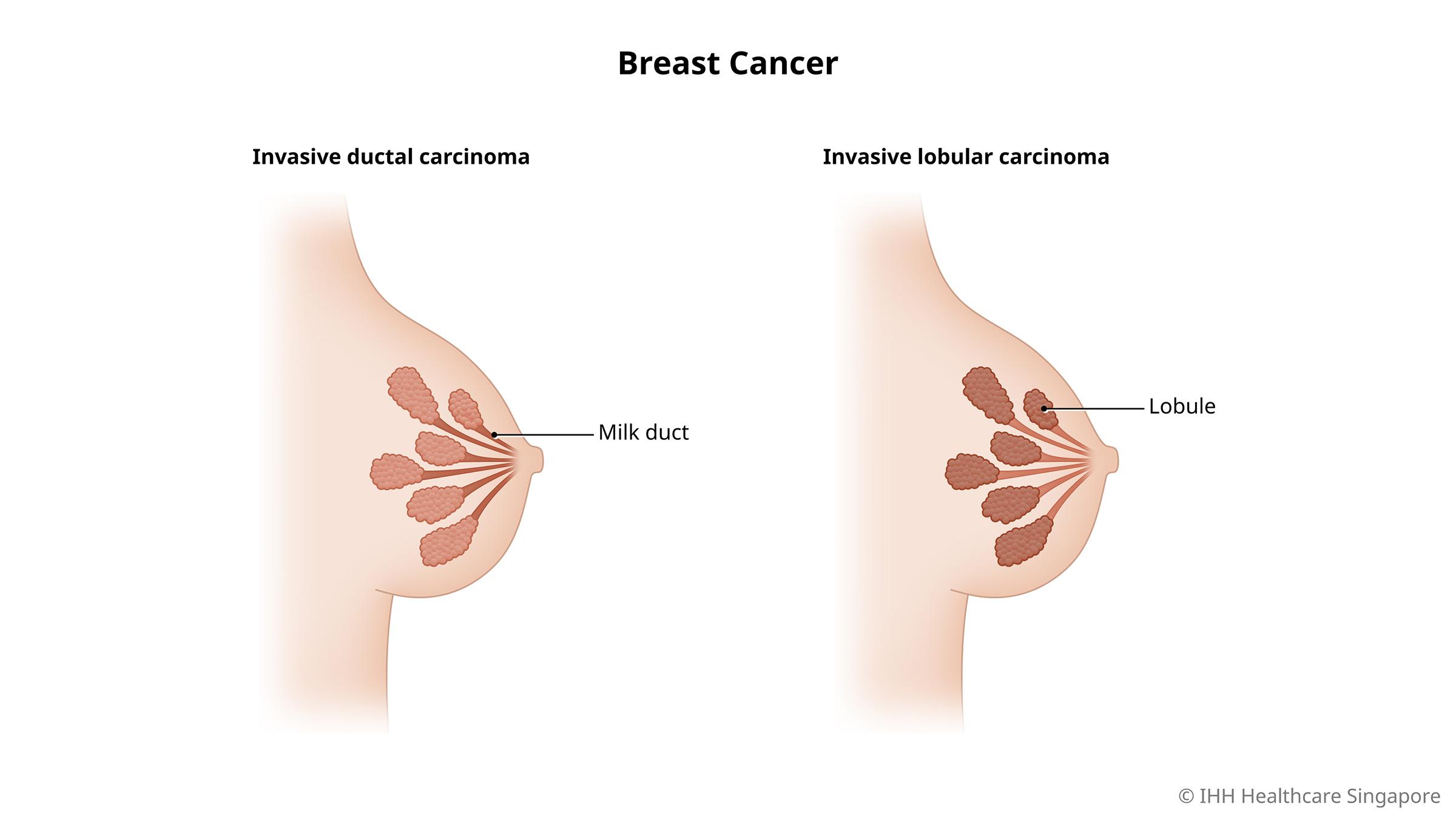 美國治療乳腺癌2023最新研究：Kisqali有效降低乳腺癌患者復發